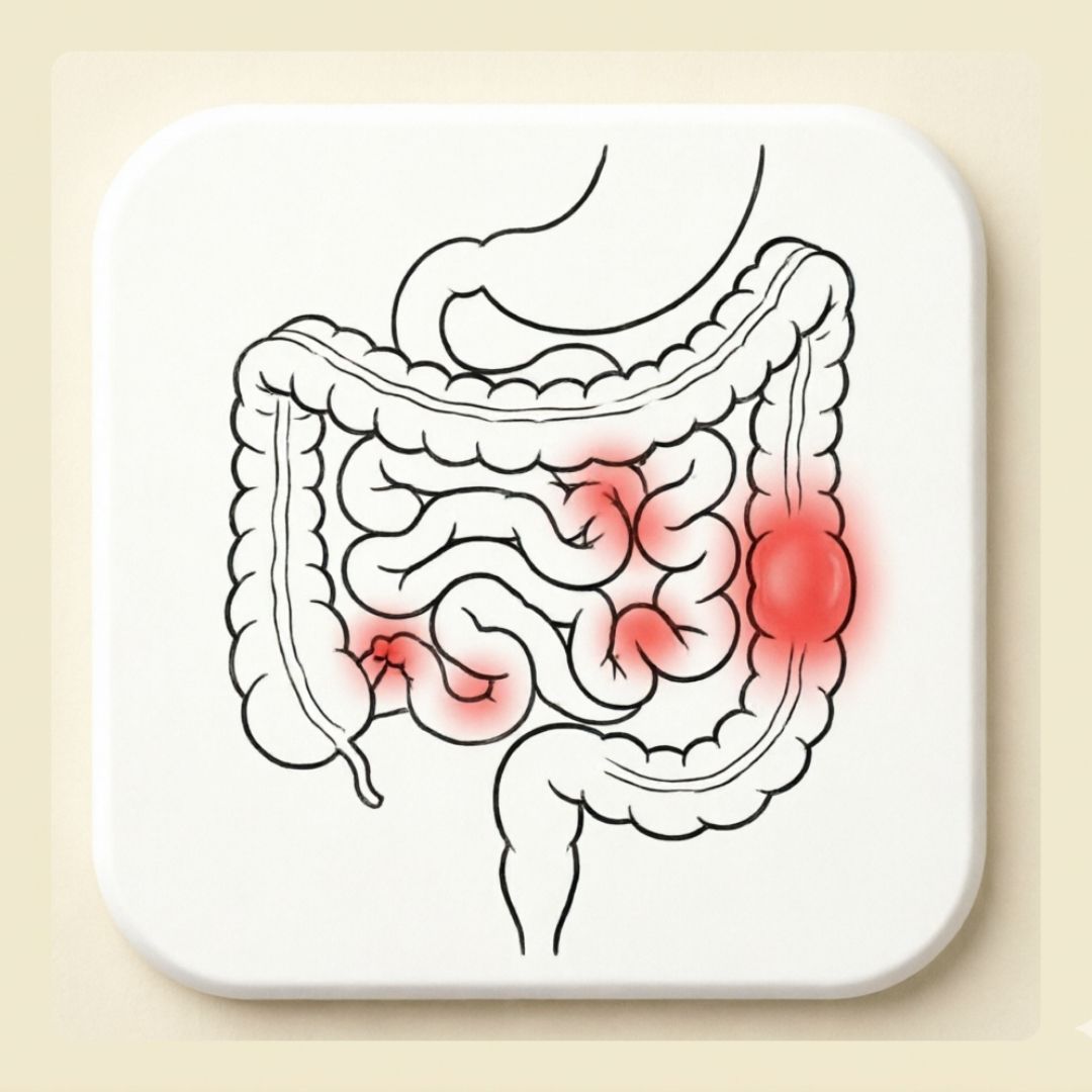 Irregular Bowels
